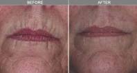 Chicago Laser Wrinkle Reduction